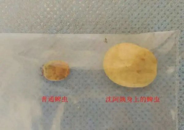 大腿上长出指甲盖大小的肿块，医师诧异：这是虫子！从医43年来见过最大的...